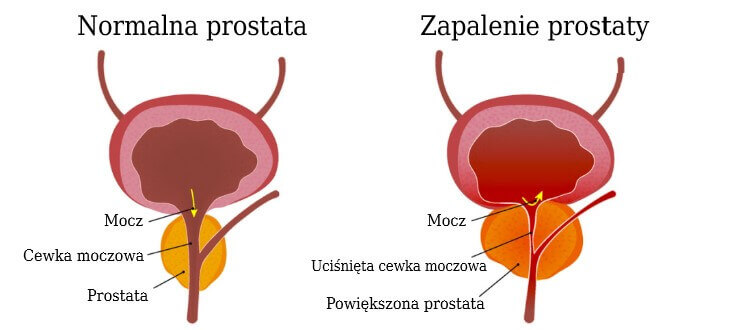 dieta zapalenie prostaty