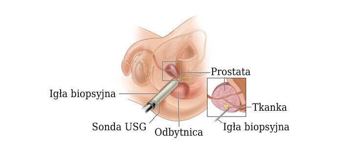 Widok biopsji prostaty w przekroju