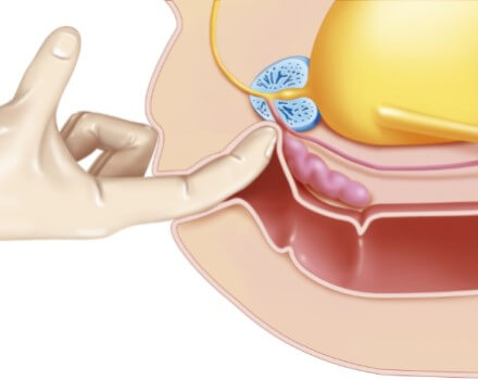 masaż prostaty podczas erekcji penis przed i po szerokości