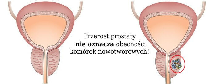jak zmniejszyć przerost prostaty)